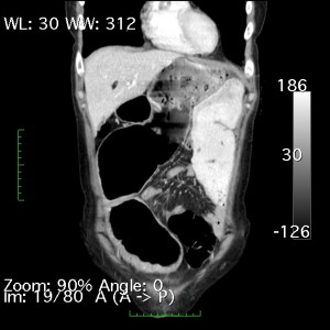 Coronal ST 3.0.0001