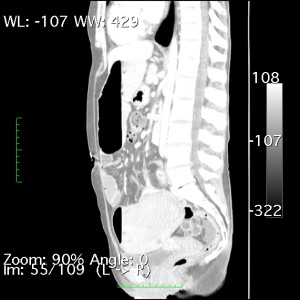 Sagittal ST 3.0.0001